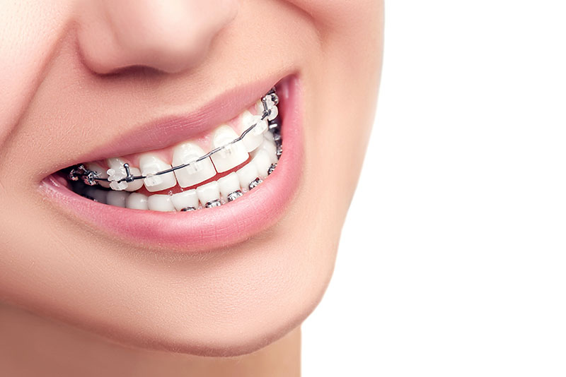 About Orthodontic Treatment
