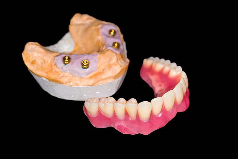 E) All on 4 Dental Implants