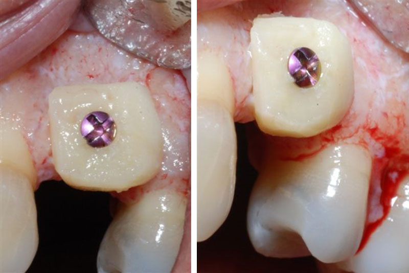 B) Bone Block Grafts and Sinus Lifts