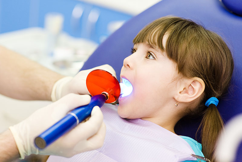 Fissure Sealants