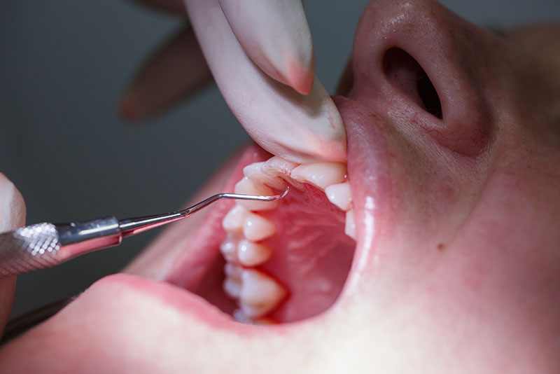 Gum Treatment: Periodontics