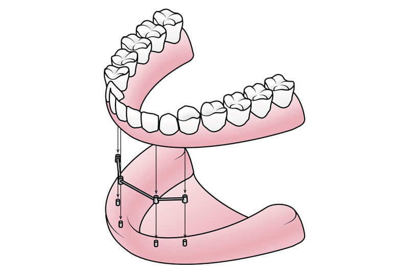 D) Implant Supported Dentures
