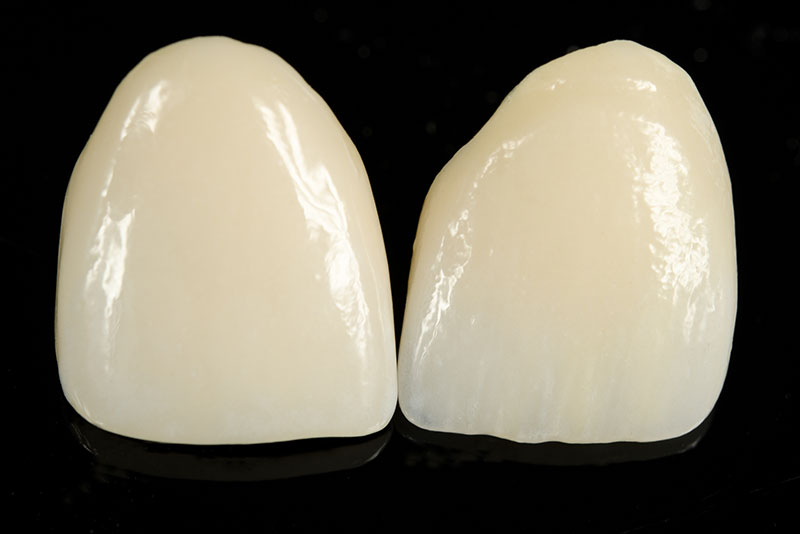 A) Porcelain Veneers