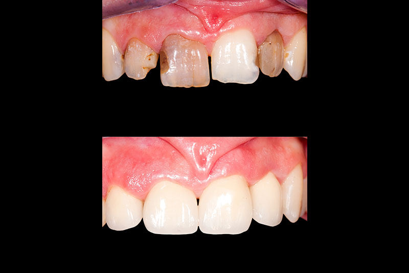 Smile Makeovers