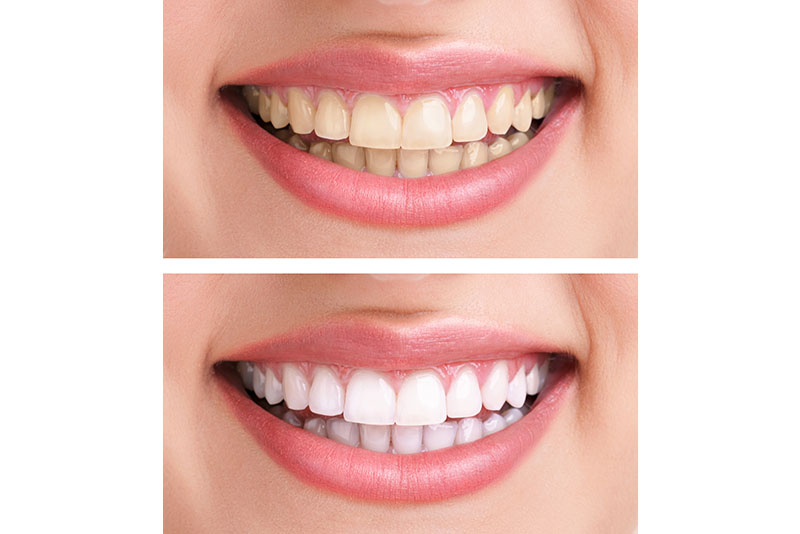 C) Teeth Whitening