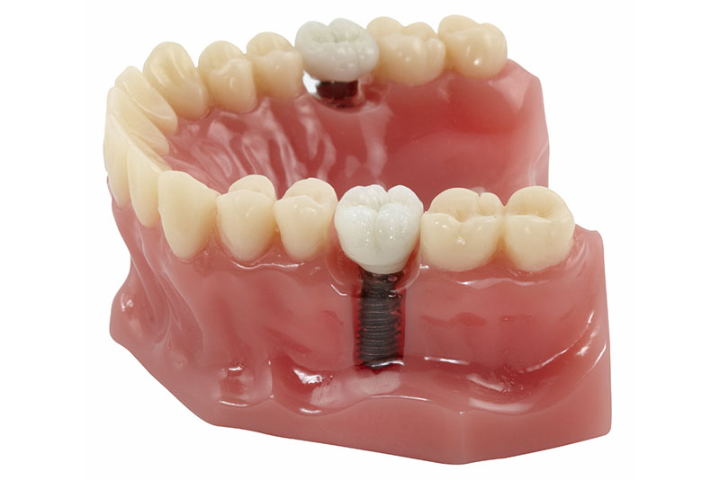 A) The Single Tooth Implant
