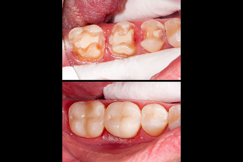 Tooth Coloured Fillings