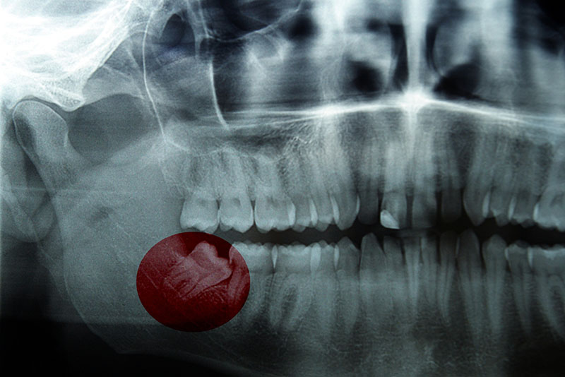 Wisdom Teeth